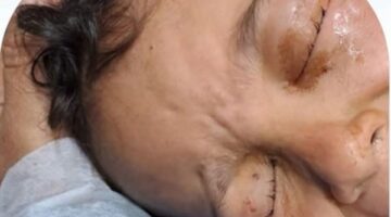 معجزة طبية في دسوق .. فريق أطباء ينقذ بصر 3 أطفال أشقاء من العمى